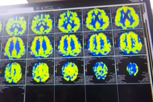 Dünyanın ilk invaziv BCI cihazına Çin'den onay